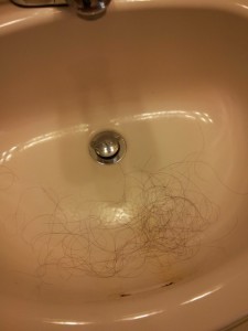 losing hair after having a baby